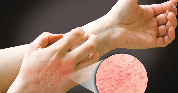 allergic glove allergies